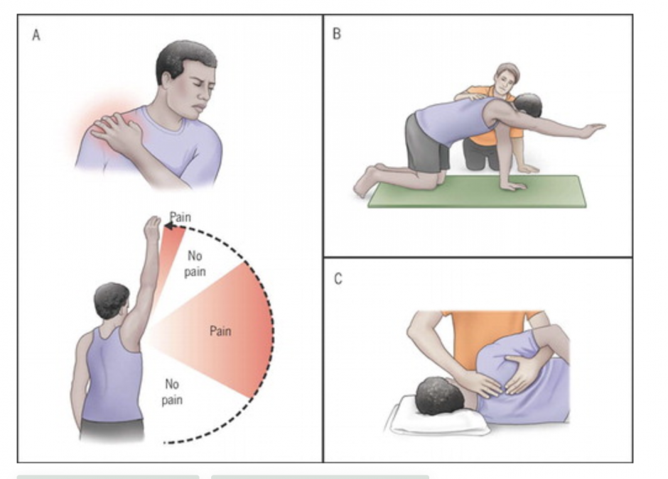 Shoulder rehabilitation in London Ontario Physiotherapy in London